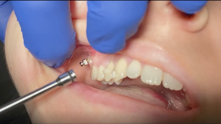 MICROSCREWS